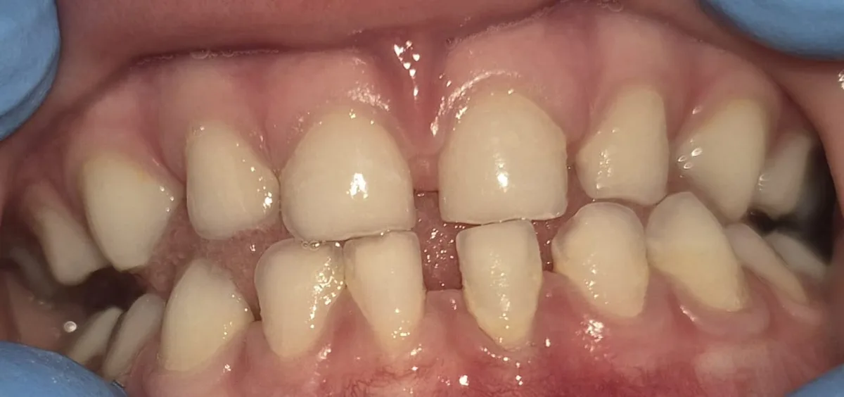 Dente sob luz normal — biofilme bacteriano invisível a olho nu