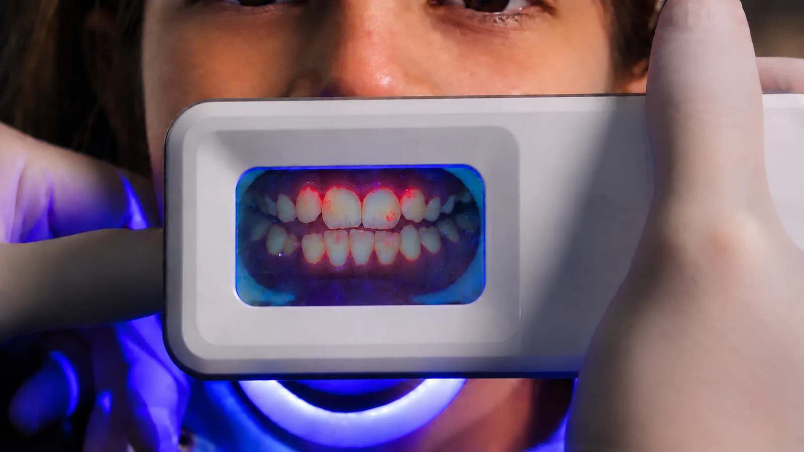 QScan Plus em uso — tecnologia QLF revelando biofilme em vermelho